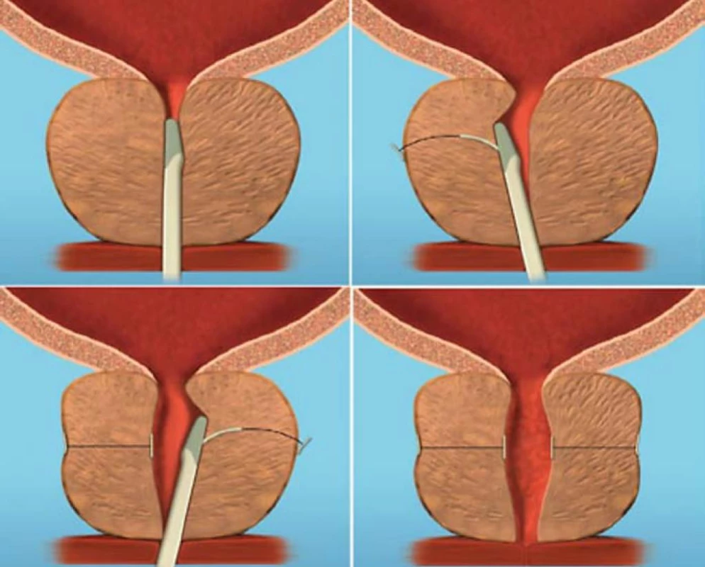 Schéma zavedení implantátu UroLift.