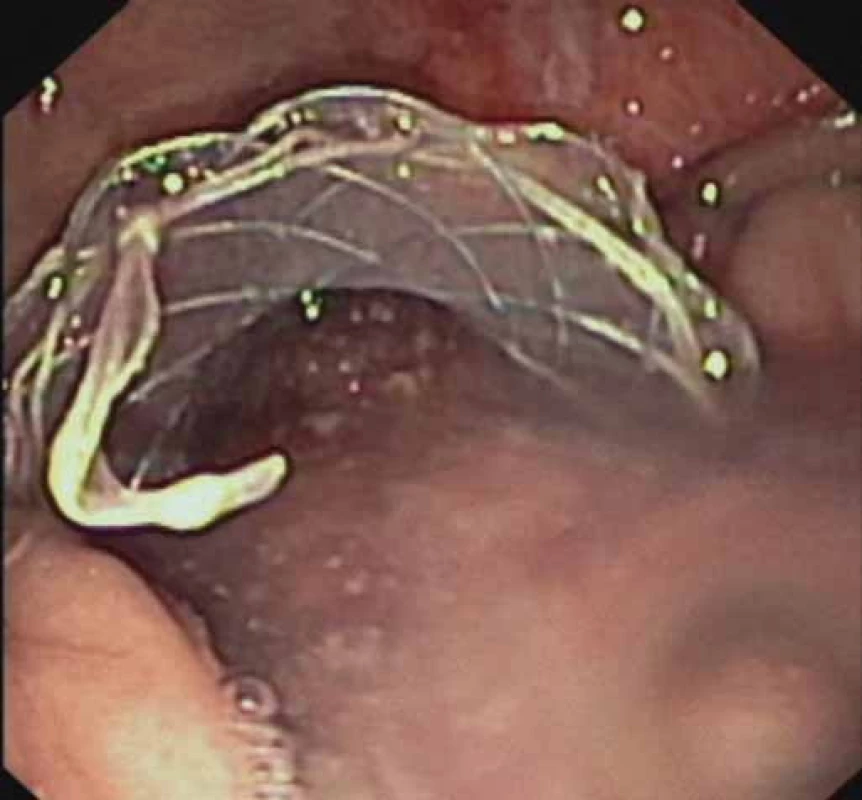 EUS-transgastrálna drenáž WOPN pomocou FC-SEMS (NAGI™ stent) – odtok skalenenej tekutiny z dutiny nekrózy po implantácii stentu.
Fig.2. EUS-guided transgastric drainage of WOPN using a FC-SEMS (NAGI™ stent) – outfl ow of a turbid liquid out of the necrotic cavity after stent implantation.