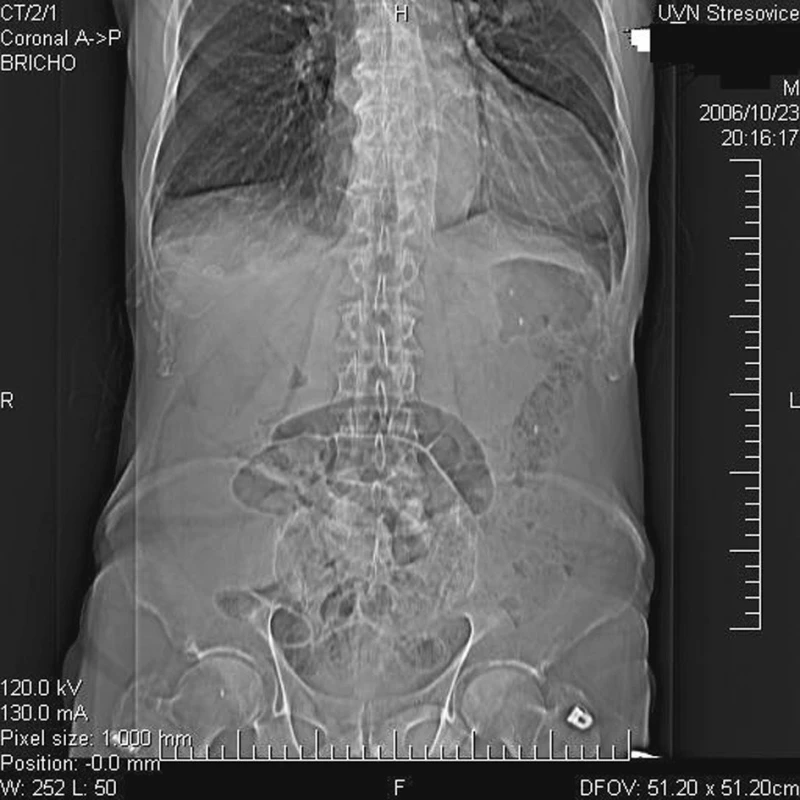 Nativní CT topogram: Izolovaná distenze kličky tenkého střeva
Fig. 1. Native CT topogram: The isolate distension in the small intestine