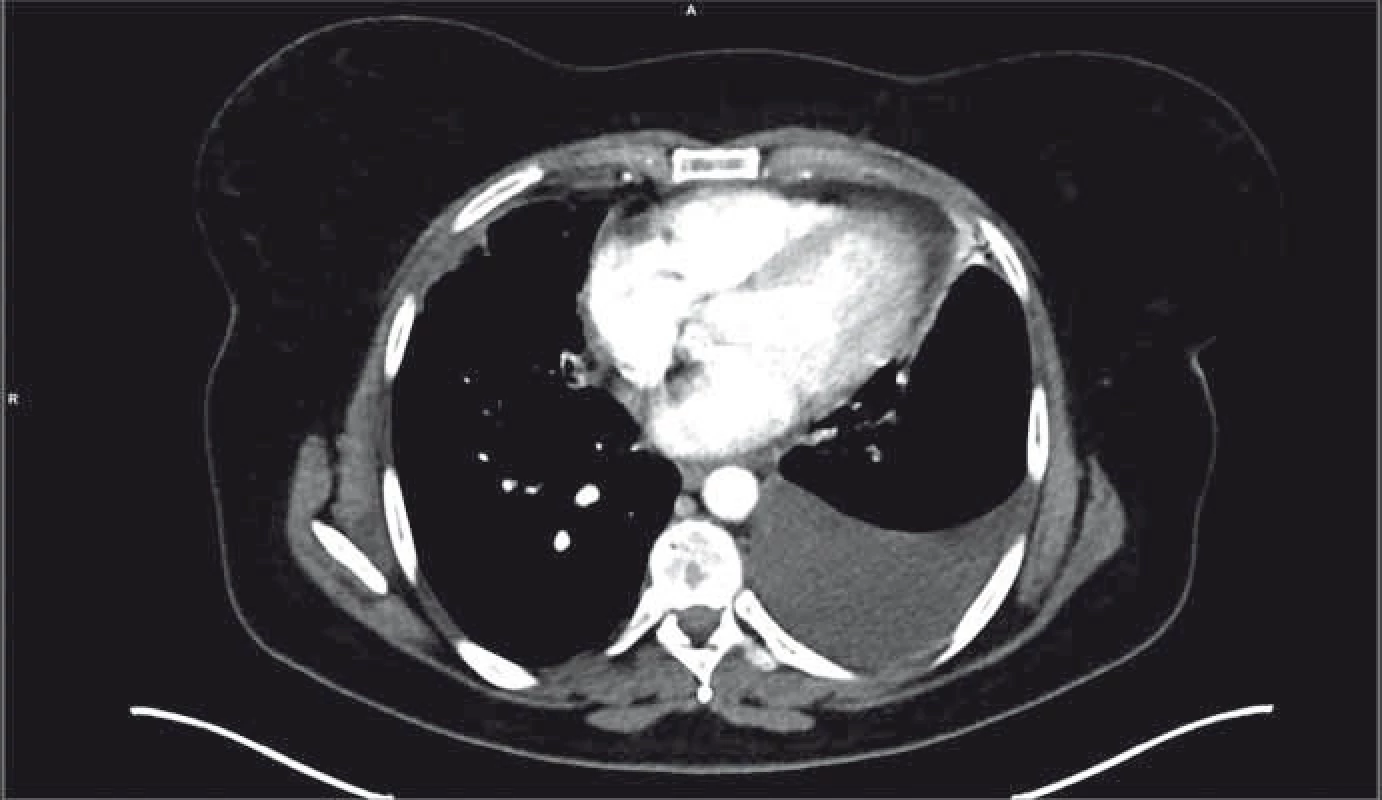 PET/CT nález po progresi na léčbě osimertinibem.