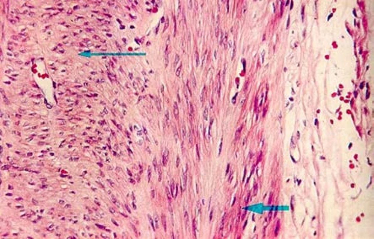 Mikroskopický obraz – leiomyom
Fig. 5. Microscopic image – leiomyoma
