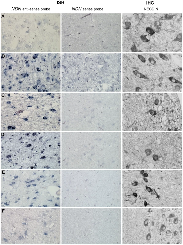 <i>NDN</i> expression in PWS patients.