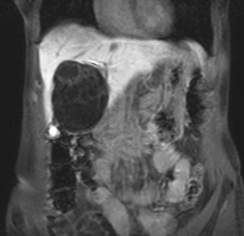 Biliární cystadenom jater s nepravidelnými okraji a septací
Fig . 6. Biliary cystadenoma of the liver with irregular margins, septated