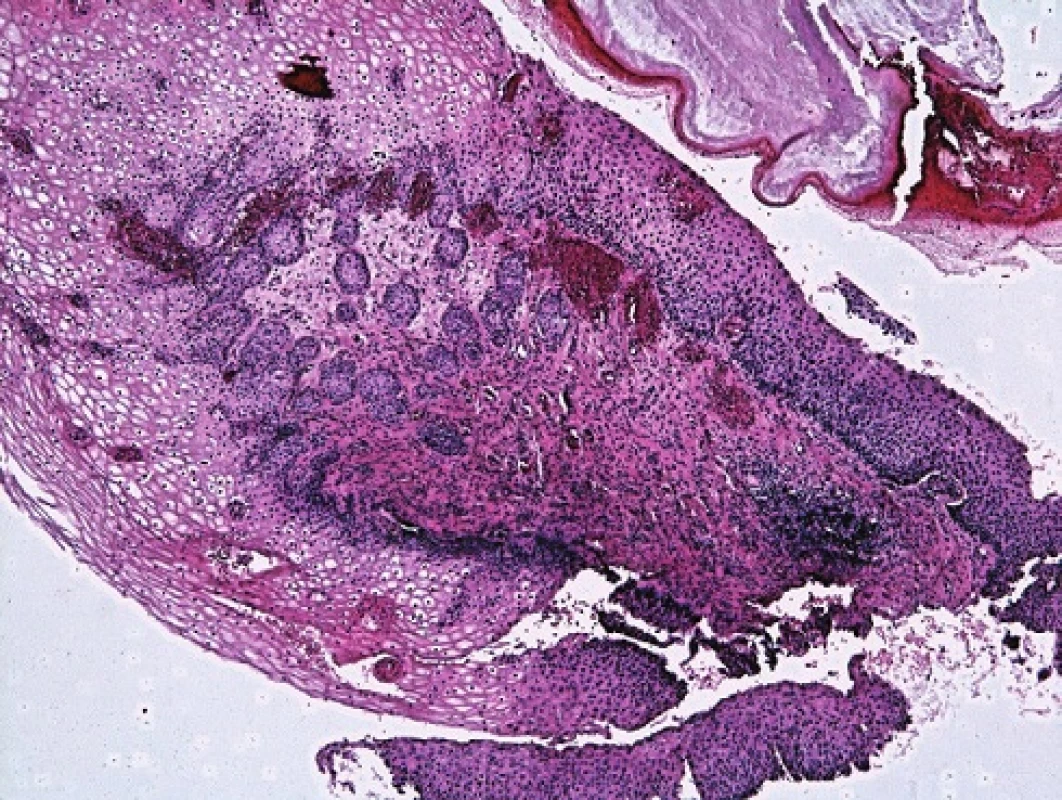Atypické buňky z pohledu screenera. A,B: Vyřazeno s pracovní diagnózou AGC NOS. Cytopatolog hodnotí jako H SIL. C: Minibiopsie s nálezem dlaždicové metaplazie a úsekÛ CIN III.