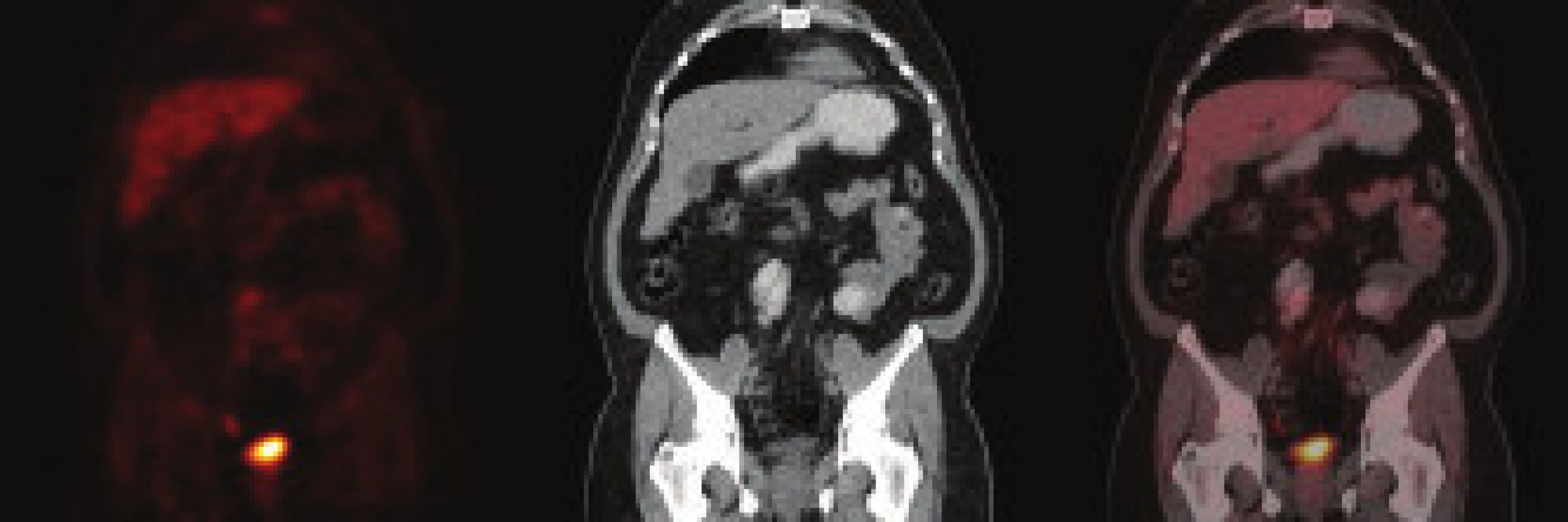 Kontrolní PET/CT pacienta – kazuistika 2. Za 12 měsíců po zahájení léčby je PET/CT obraz téměř normalizován. Retroperitoneální masa se významně zmenšila. Zbývá pouze nepatrný proužek parailicky vlevo, který již zvýšený metabolizmus glukózy nevykazuje. Ureterální cévka extrahována, spontánní odtok moči obnoven.