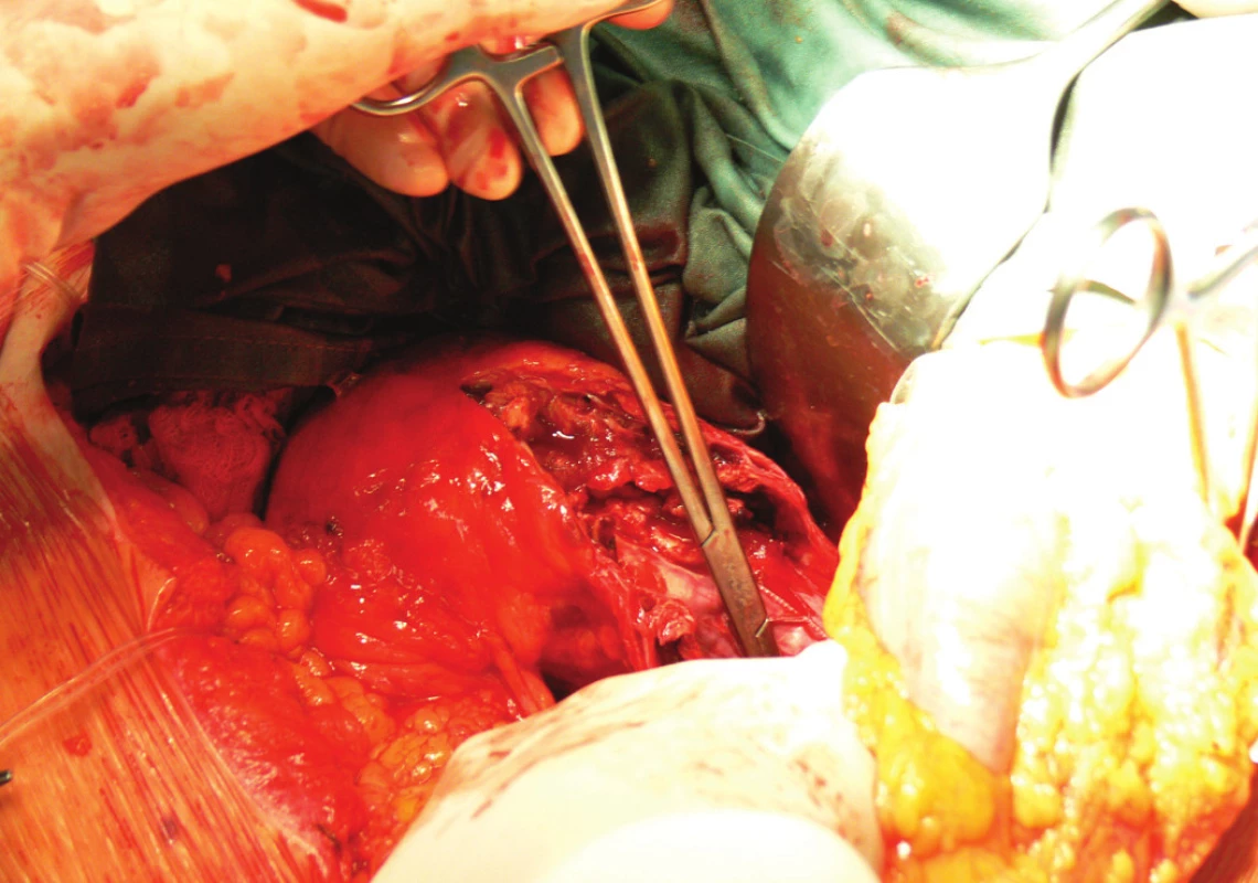 Extrakce stentgraftu, subdiafragmaticky naložená aortální svorka
Fig. 10: An extraction of the stentgraft, a subdiaphragmatic laden aortic clamp