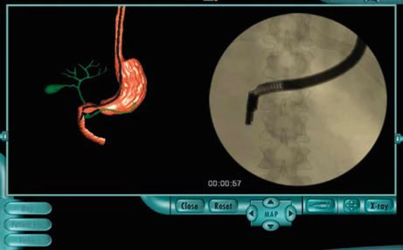 Modul pro ERCP. Skiaskopický a virtuální topografický obraz poskytují informaci o poloze duodenoskopu.
Fig. 6. Module for ERCP. X-ray and virtual topography maps provide information on the position of the duodenoscope.
