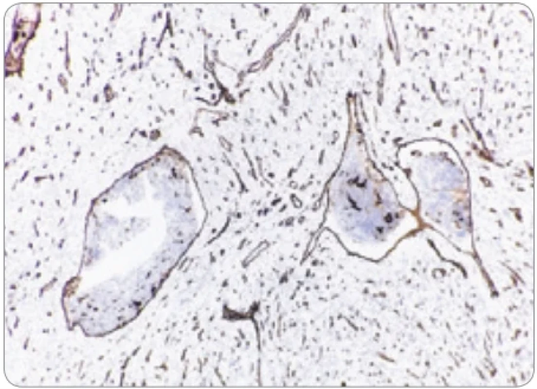Imunohistochemická pozitivita endotelu ciev obsahujúcich agregáty endometriálneho tkaniva na CD31. (Zväčšenie 200×).