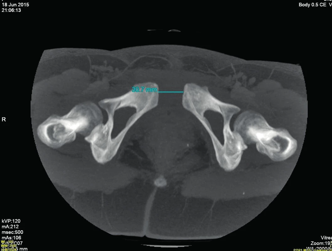 CT snímek, rozesup spony 3 cm
