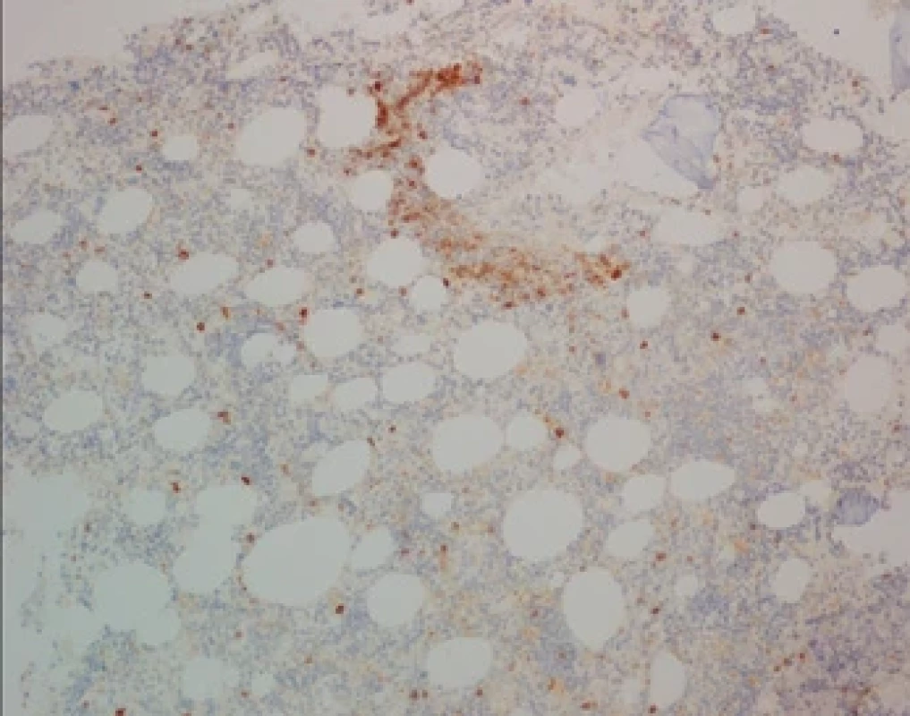 Histologie kostní dřeně po kúře venetoklax + azacitidin (FNHK, Fingerlandův ústav patologie) – imunohistochemický průkaz antigenu CD23, pozitivita nádorových buněk (CLL), do 5 % z celkové buněčnosti.