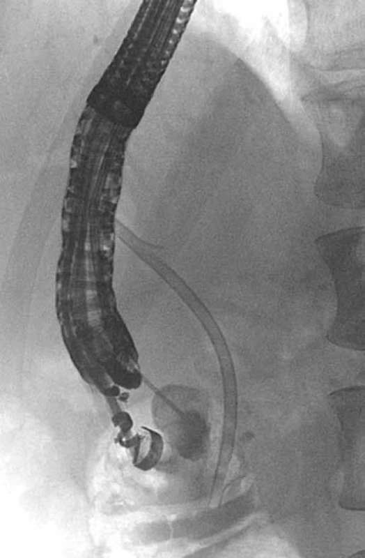 EUS – cystography during EUS-CDS in a patient with GP with a cyst in the duodenal wall and a stricture of distal common bile duct, plastic stent in the common bile duct (patient 4).
Obr. 6. EUS – cystografia počas EUS-CDS u pacienta s GP a cystou v stene duodéna a stenózou distálneho žlčovodu, plastikový stent v žlčovode (pacient č. 4).