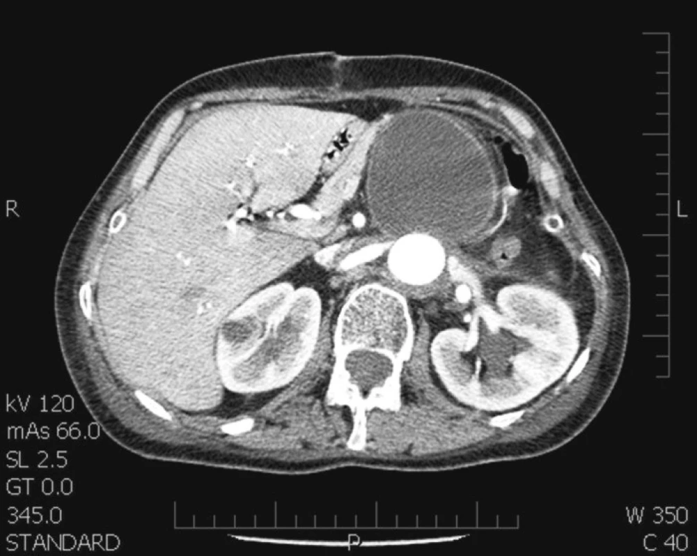 CT řez v úrovni pankreatu – patrné oválné retroperitoneálně uložené ložisko naléhající na ocas pankreatu (kolekce chylu)
Fig. 3. A pancreatic level CT section – apparent oval retroperitoneal focus, adjacent to the pancreatic tail (collection of the chyle)