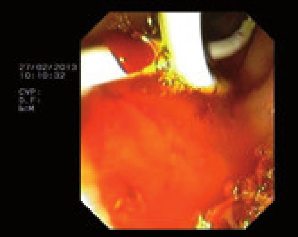 Double pig tail stent v endoskopickém obrazu.
Fig. 5. Double pig tail stent in the endoscopic image.