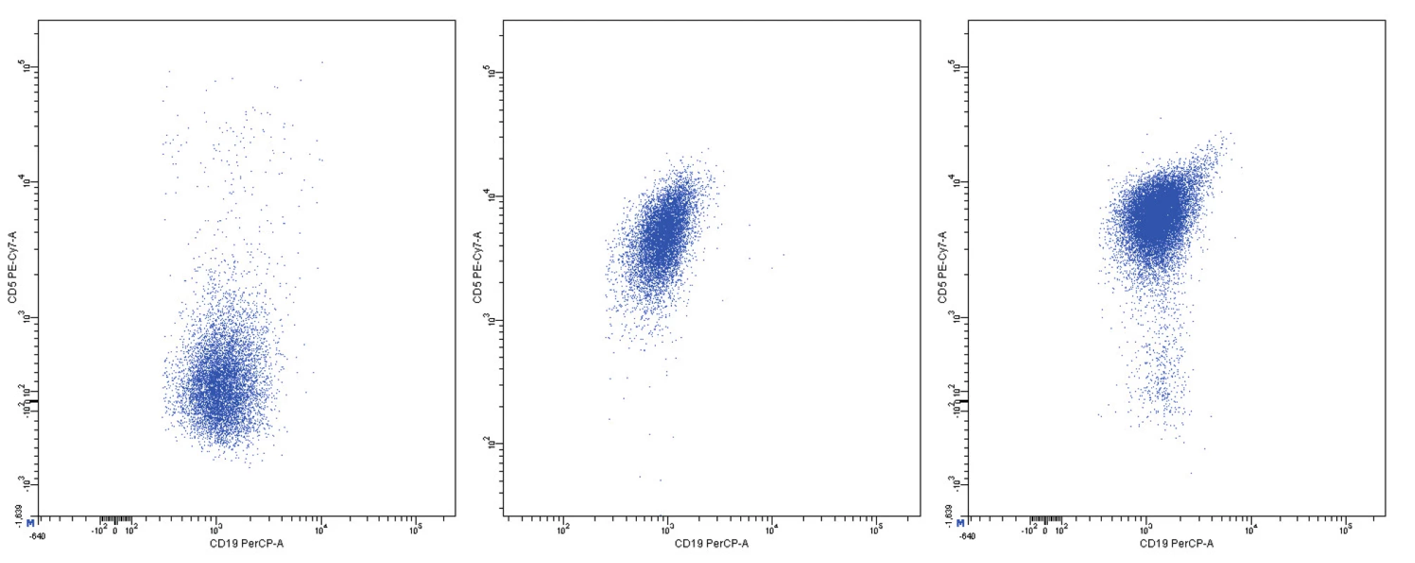 Variabilní exprese znaku CD5, dvouparametrové dot plot diagramy, CD19 na vodorovné a CD5 na svislé ose, logaritmická škála exprese na obou osách