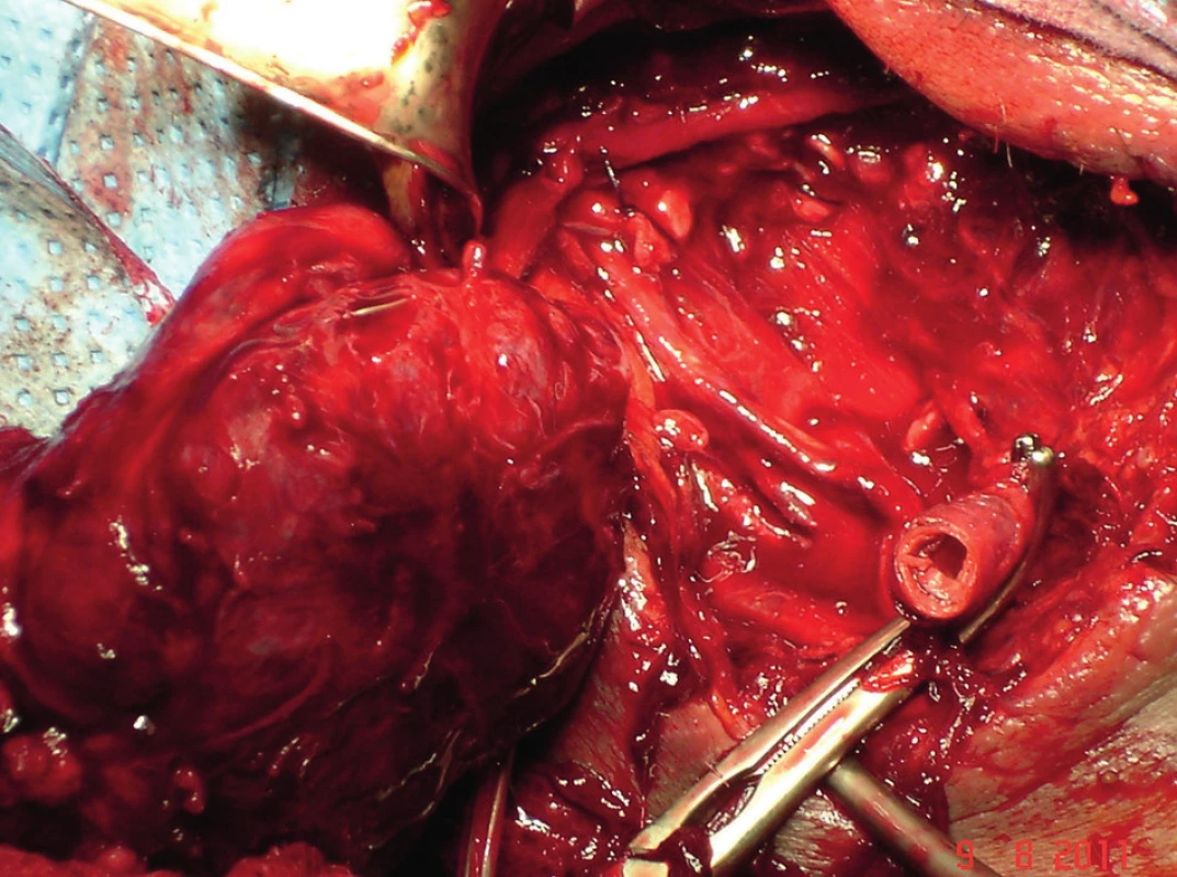 Zvednutí celého tumoru po přetnutí ACC
Fig. 4: Lifting of the whole tumour after cutting the ACC