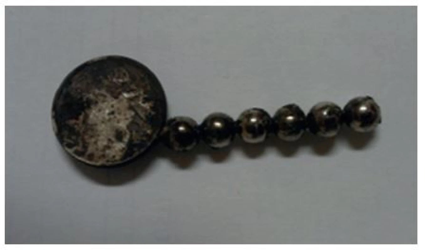 Cizí tělesa z ilea
Fig. 3: Removed magnetic balls and a metal body