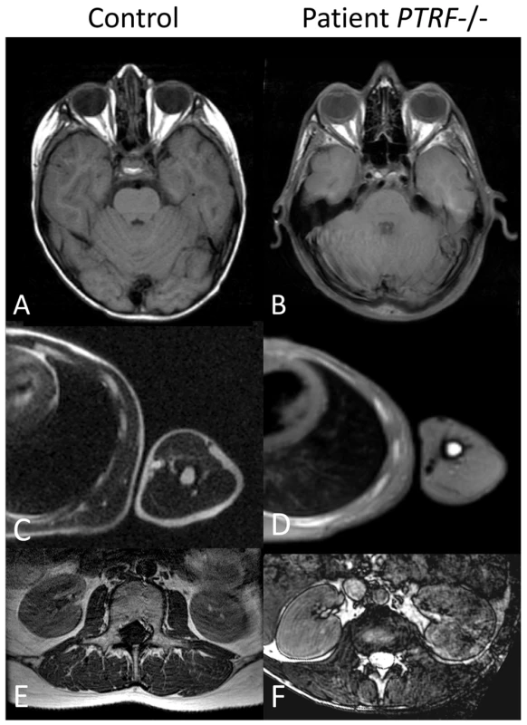 Abnormal fat distribution in patients with <i>PTRF-CAVIN</i> mutations.