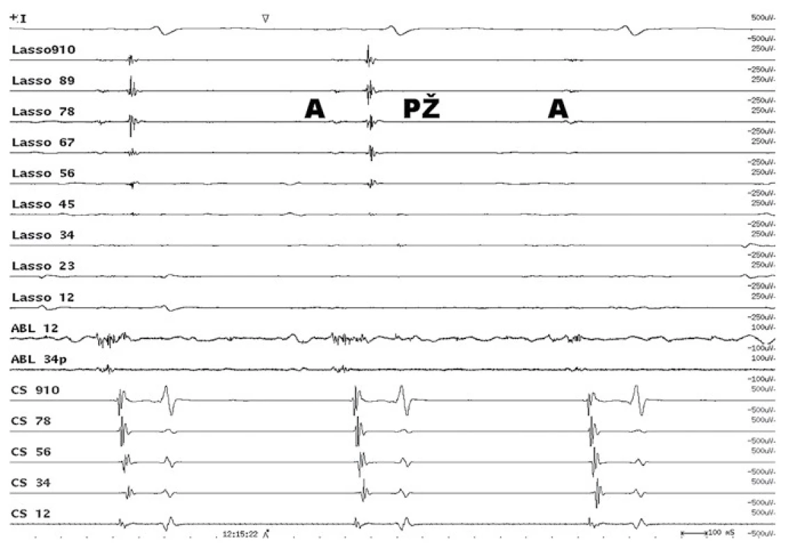 Intrakardiální EKG záznam elektrické izolace plicní žíly. 
Cirkulární vyšetřovací Lasso katétr snímá elektrickou aktivitu ze síně (A) a pravé horní plicní žíly (PŽ). Po elektrické izolaci plicní žíly zůstává elektrická aktivita síně (A) a mizí elektrická aktivita plicní žíly (PŽ). 
Lasso – cirkulární katétr, který snímá elektrické potenciály v ústí plicní žíly. ABL – elektrické potenciály v ablačním katétru. CS – elektrická aktivita z levostranných srdečních oddílů v koronárním sinu