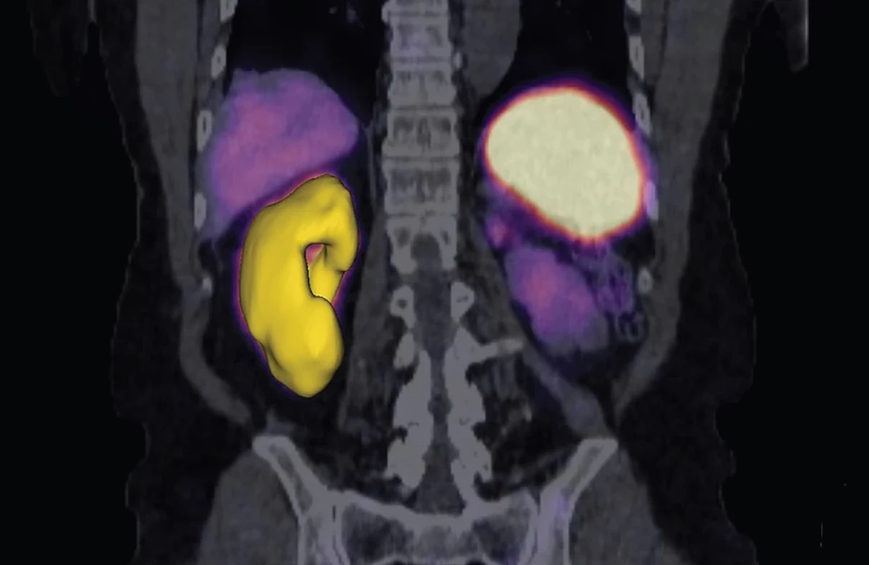 CT segmentace ledviny (objem pravé ledviny 235 ml).