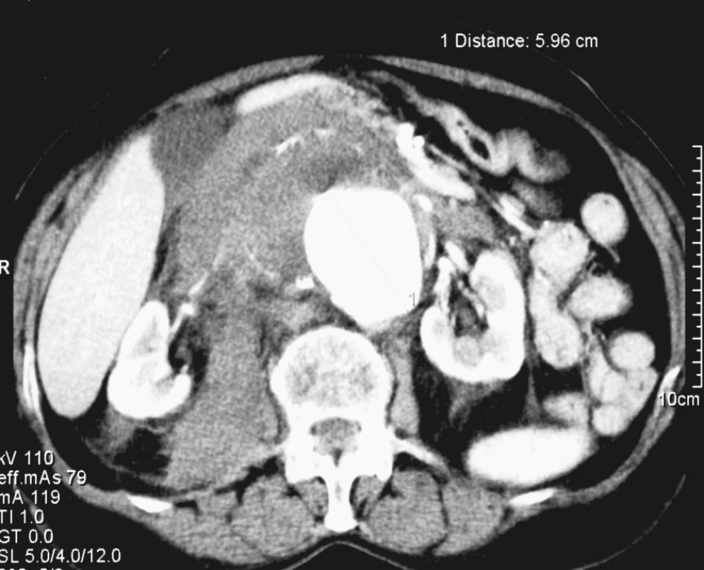4. Rupturované velké juxtarenální AAA u 82leté nemocné
Fig. 4. Ruptured large juxtarenal AAA in a 82-year old female patient