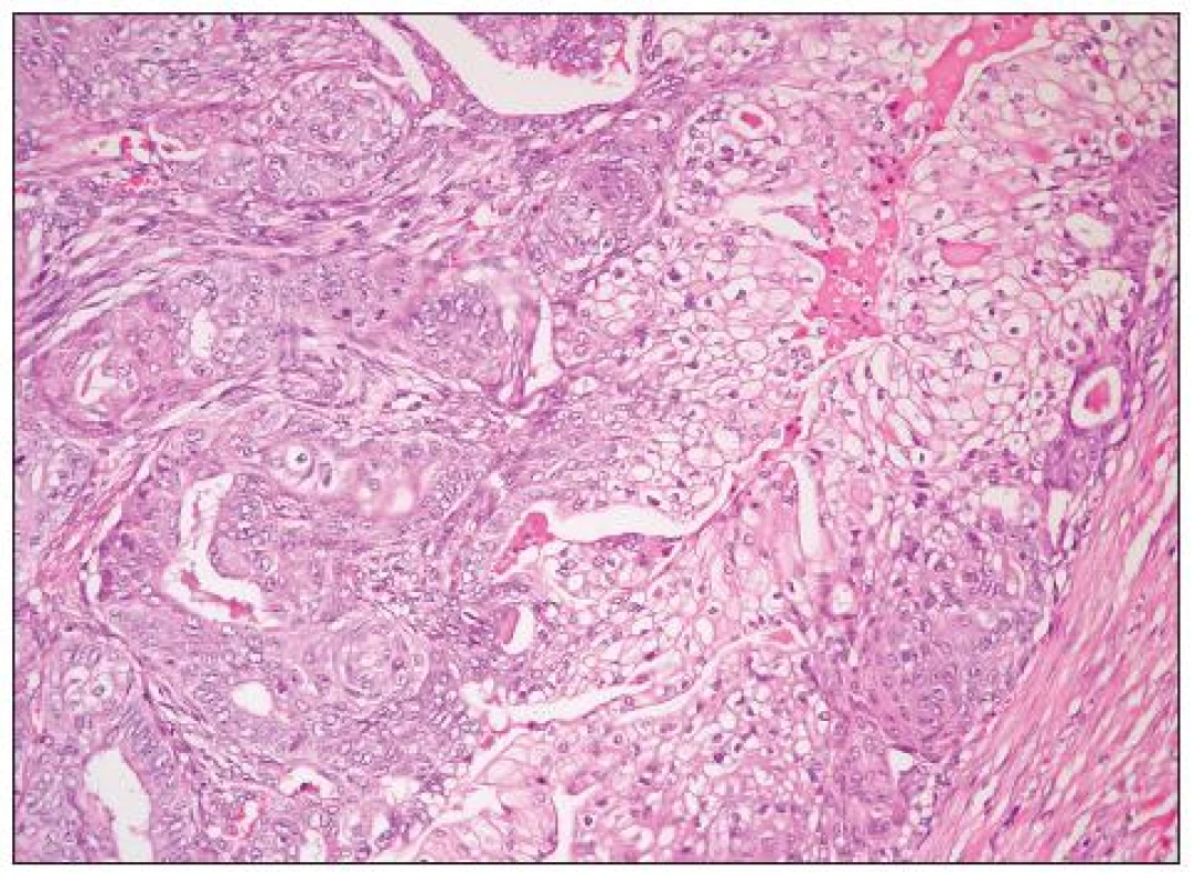 Dobře diferencovaný endometroidní adenokarcinom (G1) s extenzivní dlaždicobuněčnou diferenciací se světlobuněčnou přeměnou (HE, 200krát)