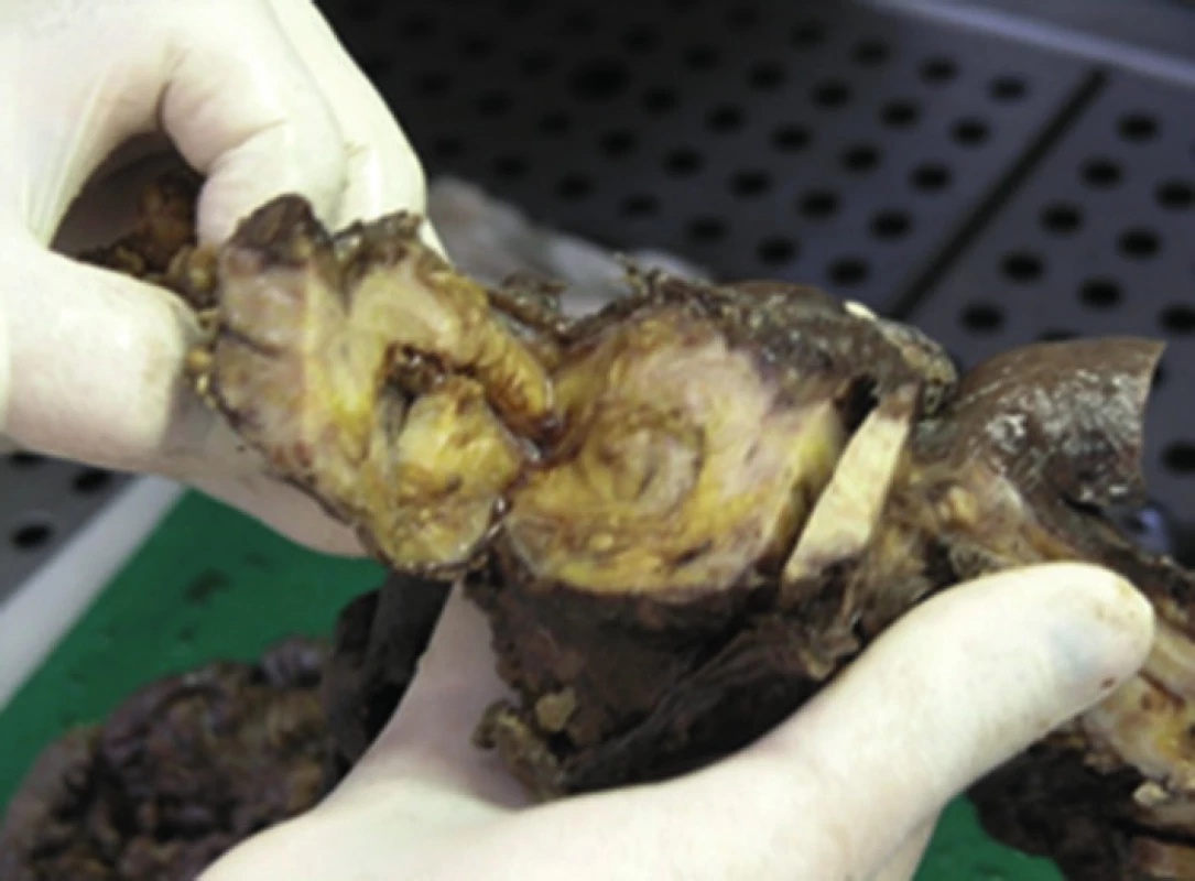 Makroskopické pitevné nálezy poukazujú na rozsah a hrúbku osifikácie zostávajúcej časti čreva
Fig. 7: Macroscopic autopsy findings indicate the extent and thickness of ossification of the residual part of the intestine