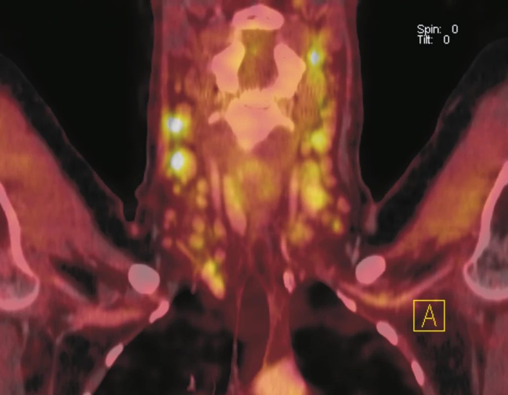 Fúze PET a CT řezů v koronální rovině. Na krku je v lymfatických uzlinách oboustranně patrná zvýšená akumulace <sup>18</sup>F-FDG. Největší uzlina vpravo dosahuje velikosti 15x13 mm, vlevo 16x13 mm. Biopticky ověřena reaktivní lymfadenitida u imunosuprimované nemocné po imunochemoterapii a autologní transplantaci krvetvorných kmenových buněk pro relabující lymfom.