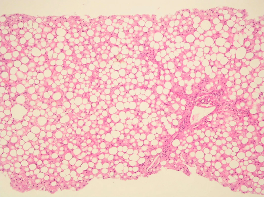Steatóza jater při léčbě kortikoidy. Těžká (85–90 % hepatocytů) smíšená, převážně velkokapénková steatóza, mírná zánětlivá celulizace, mírná periportální a perisinusoidální fibróza. Barvení: H&amp;E, zvětšeno 10x.