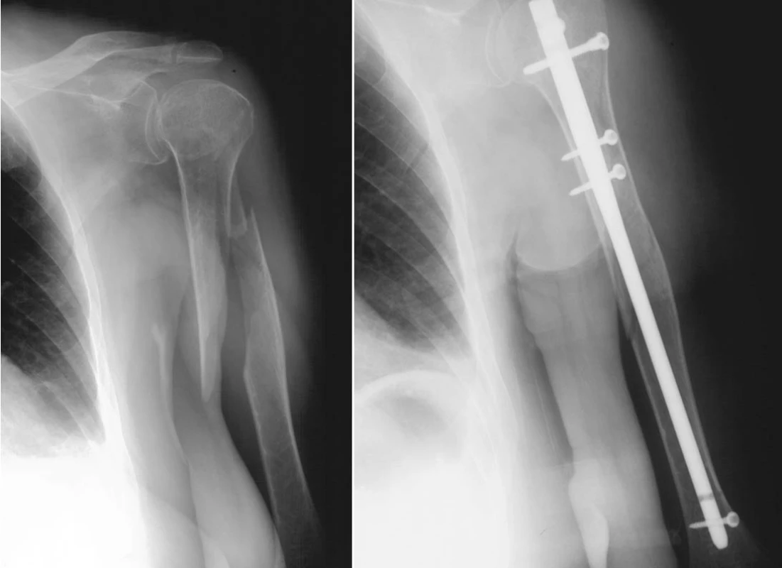 Zlomenina proximální diafýzy humeru
a) úrazový snímek
b) stav po operaci s využitím metafyzárních šroubů
Pic. 7. Proximal diaphyseal humeral fracture
a) trauma view
b) postsurgical condition following a procedure using metaphyseal screws