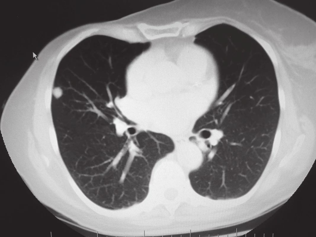 Kulovitá infiltrace ve středním laloku vpravo
Fig. 2: Coin lesion in the right middle lobe