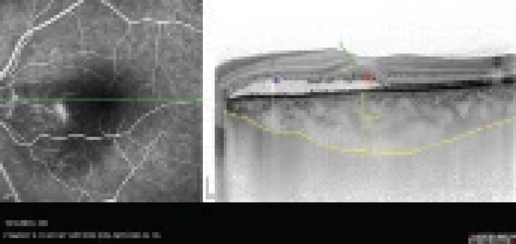 Kombinovaný snímek fluorescenční angiografie a transfoveolární lineární sken optické koherenční tomografie (Heidelberg Spectralis, Myslík Manethová)
