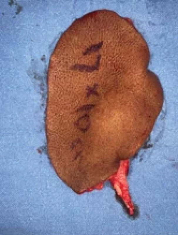 Anterolateral thigh fl ap after pedicle division.