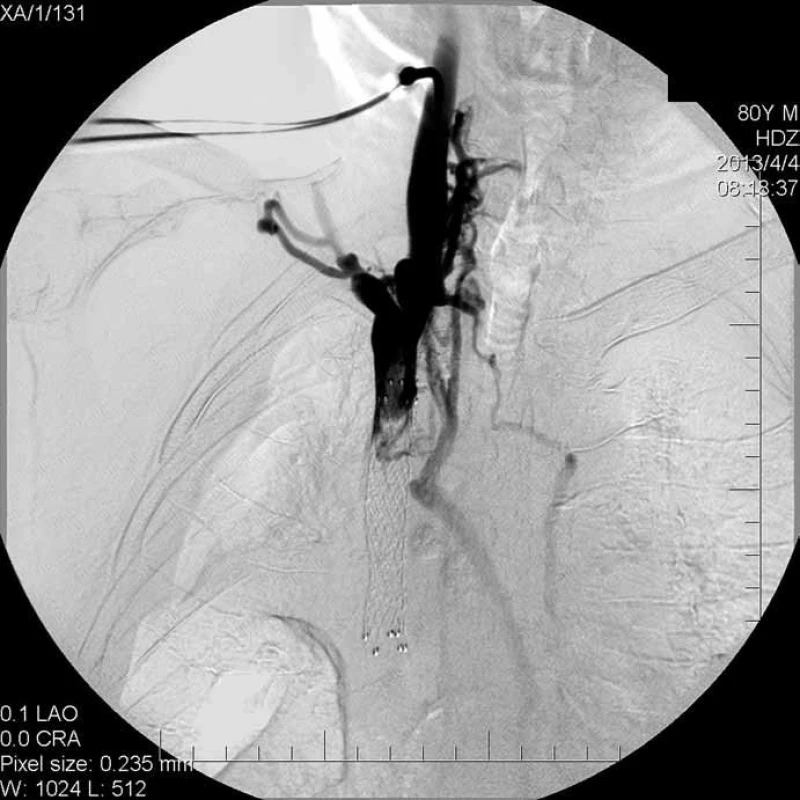 In-stent oklúzia u pacienta z prípadu 1.