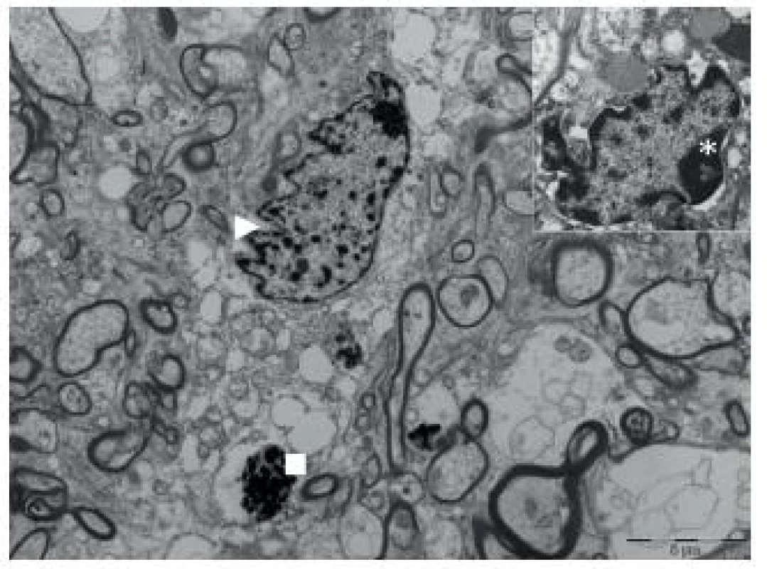 Microglial cells exhibited telolysosome with hydrophilic and hydrophobic component. Activated microglial cell, nucleus appeared to be indented (arrowhead). Vacuoles, and telolysosomes in cytoplasm (square). Asterisk indicates nucleolus (see in detail).