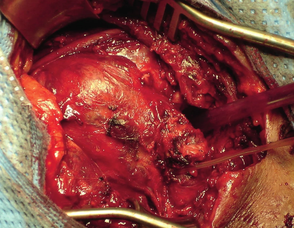 Velký prokrvácený tumor, v dolním pólu zajištěna ACC, která je arteficiálně prošita
Fig. 3: A large bleeding tumour, secured ACC in the lower pole which is artificially closed