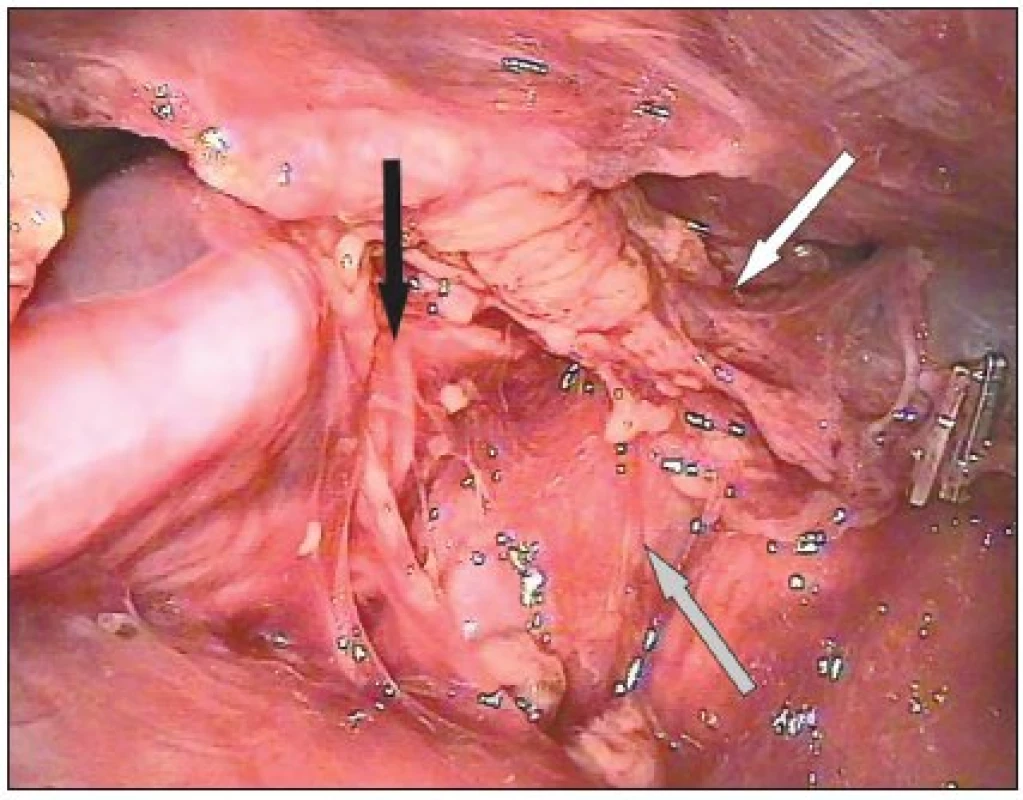 Pohled zleva na mediastinum. Vústění pravostranné v. thoracica interna (bílá šipka), horní dutá žíla (šedá šipka) a pravostranný frenický nerv (černá šipka) 
Fig. 5. Left lateral view to the mediastinum. Confluens of the right internal thoracic vein (white arrow), superior vena cava (grey arrow), and the right phrenic nerve (black arrow)