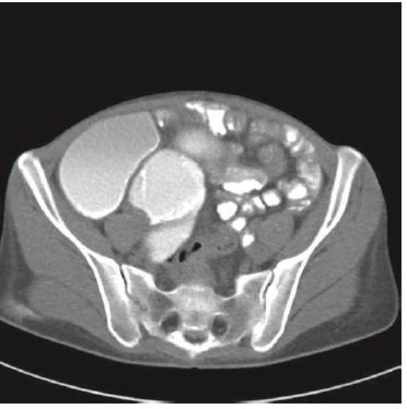 Ct-enteroklýza: dilatace kliček jejuna, gracilní kličky ilea a zánětlivé změny reliéfu.
Fig. 3. Computed tomography enterography: dilatation of jejunal loops and fragile intestinal wall with signs of inflammation.