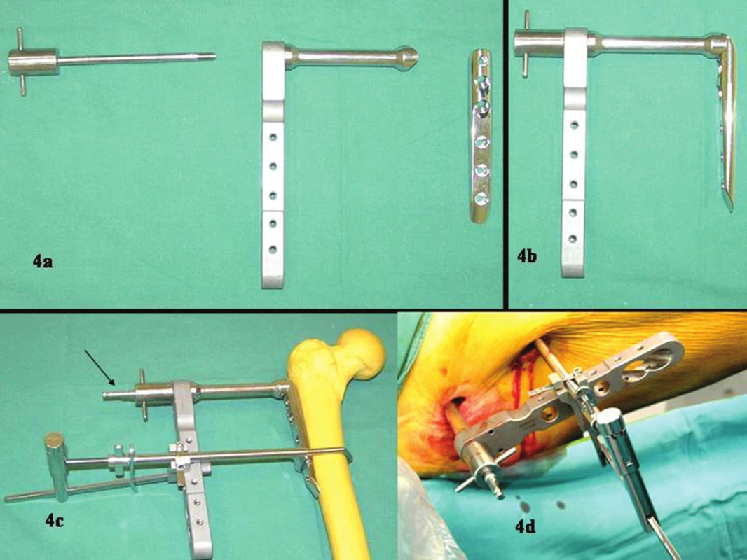 Sestavení dlahy a zavaděče. Šipka na modelu (4c) ukazuje pin, který přichycuje dlahu ke kosti. Peroperační stav (4d)
Fig. 4a-d. Preparation of the fixation device and the guide wire. The pin, fixing the device to the bone is marked with an arrow (4c). Intraoperative view (4d)