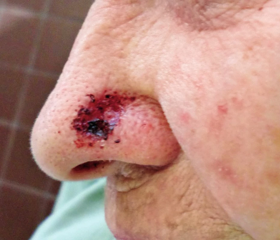 Tumorous infiltration of the nasal ala