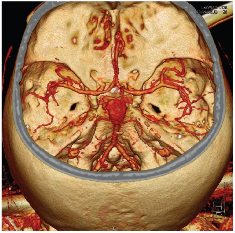Gigantická výduť v terminální oblasti bazilární tepny na CT angiografii
Fig. 1: Giant aneurysm of the basilar tip on CT angiography