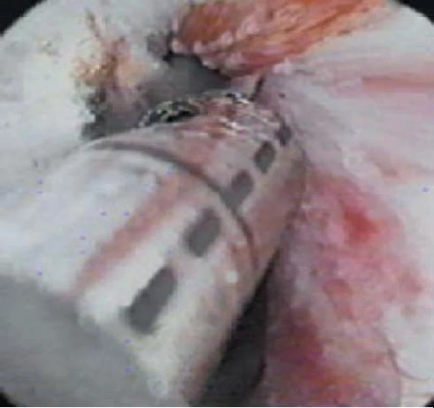 Holmium Laser Ablation of the Prostate (HoLAP).