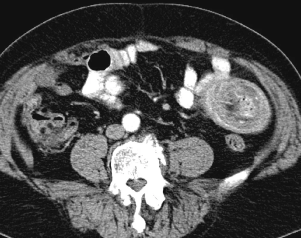 Střední část invaginace se zesílenou střevní stěnou
Fig. 2. The middle part of the invagination with a thickened intestinal wall