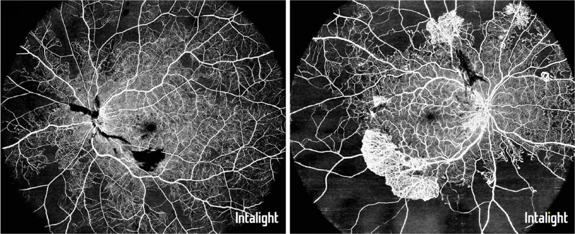 Oči pacientov s proliferatívnou diabetickou retinopatiou – UWF-OCTA snímok zobrazuje rozsah periférnej aj centrálnej nonperfúzie, blokovaným signálom pre hemoragiu, a početné neovaskularizácie