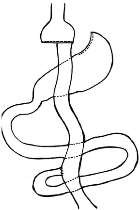 Roux-Y gastrický bypas