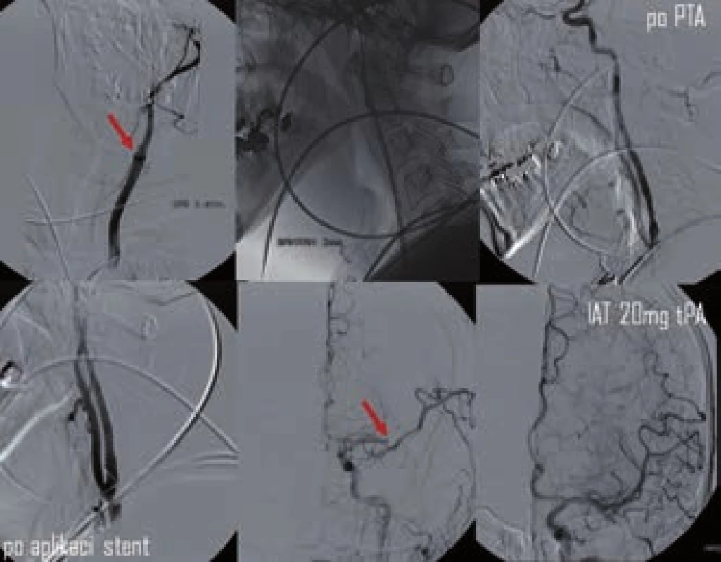 Kombinovaná reperfuzní terapie – PTA a stenting akutní okluze ACI s následnou IA trombolýzou v odstupu M2. Rekanalizace dosaženo po aplikaci 20 mg tPA (archiv KZM FN u sv. Anny v Brně).