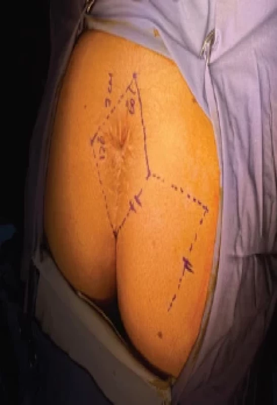 Patient’s intra-operative markings.