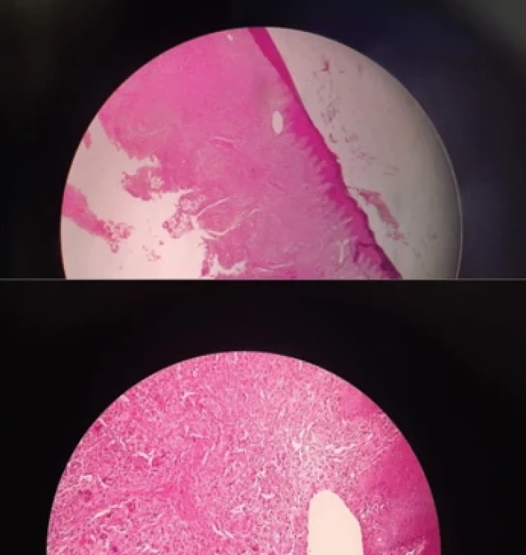 Multiple touton-type giant cells admixed with a predominantly histiocytic infi ltrate (hematoxylin and eosin, original magnifi cation and × 40, respectively).