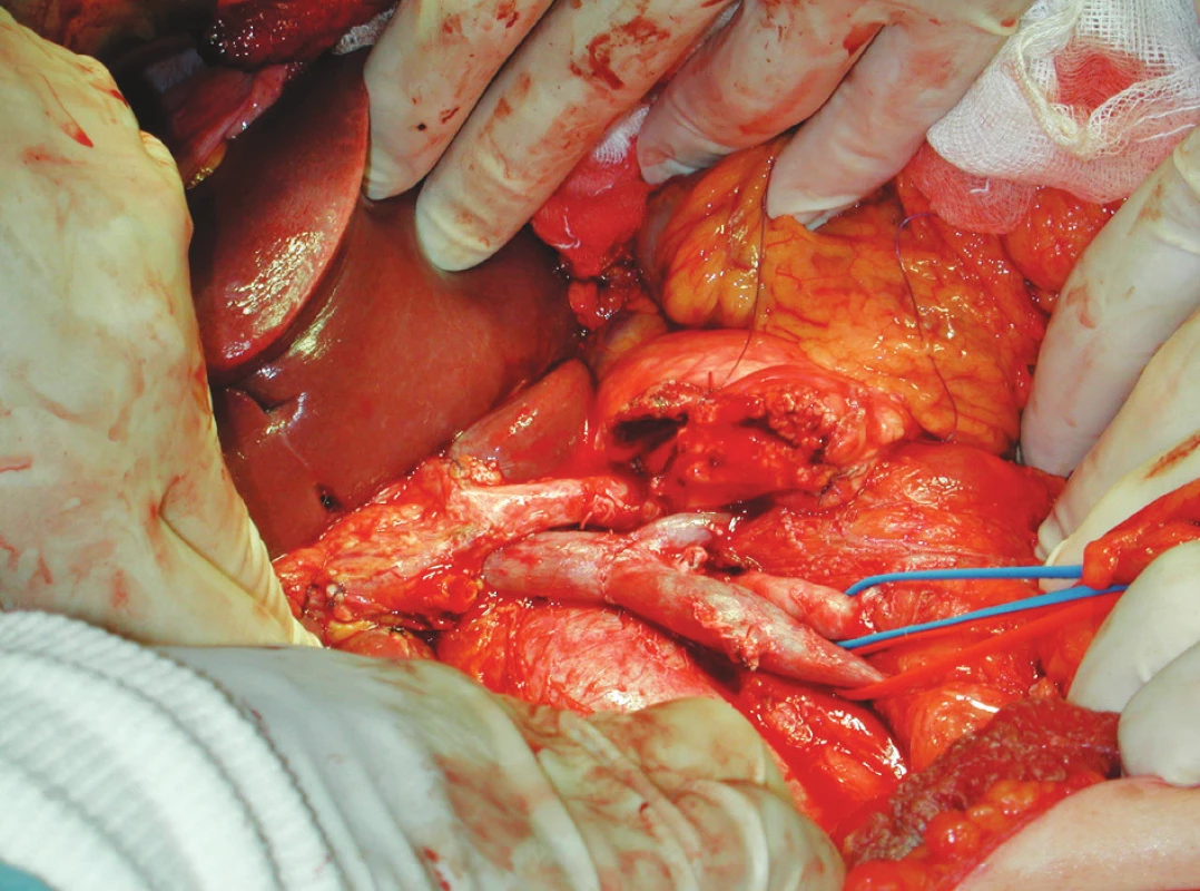 Obr. 2. Anastomóza portální žíly koncem ke konci
Fig. 2. End-to-end portal vein anastomosis