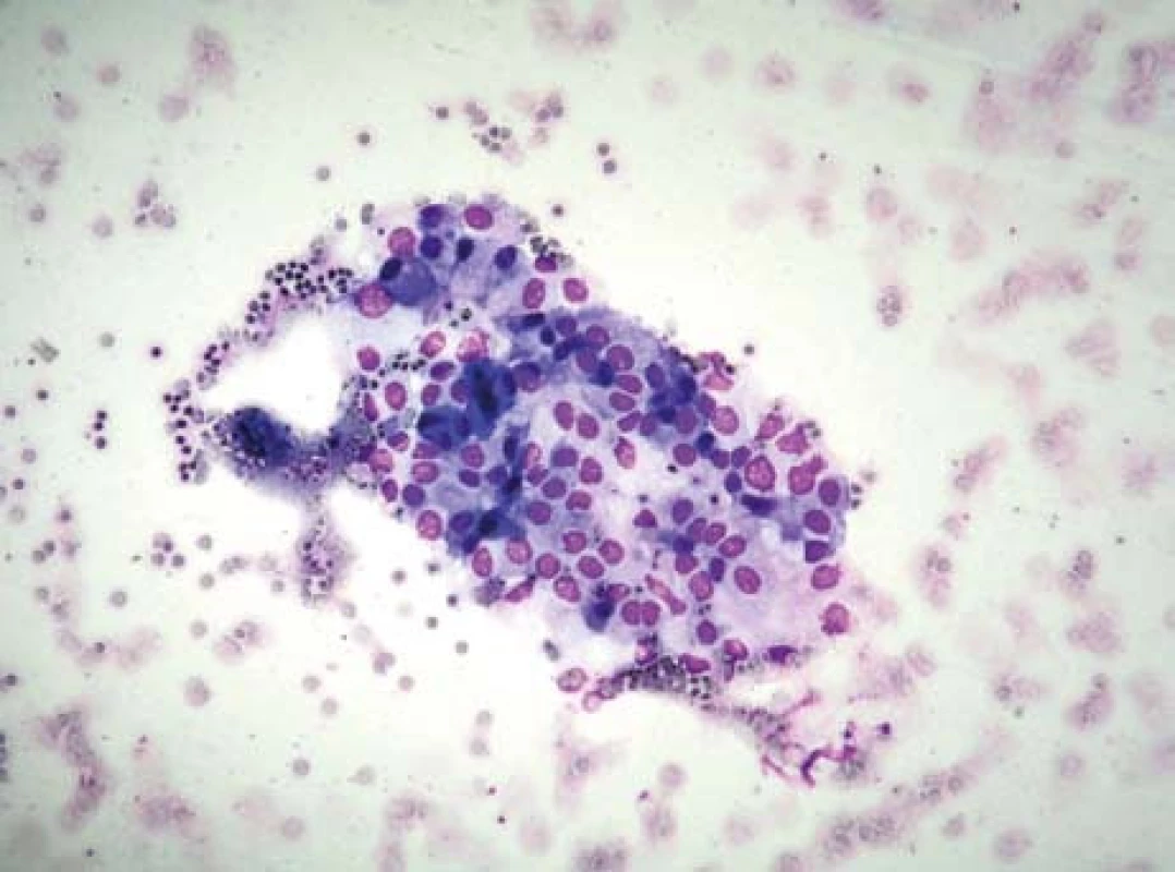 Aspirační biopsie tenkou jehlou.
Fig. 4. Aspiration biopsy using a thin needle.