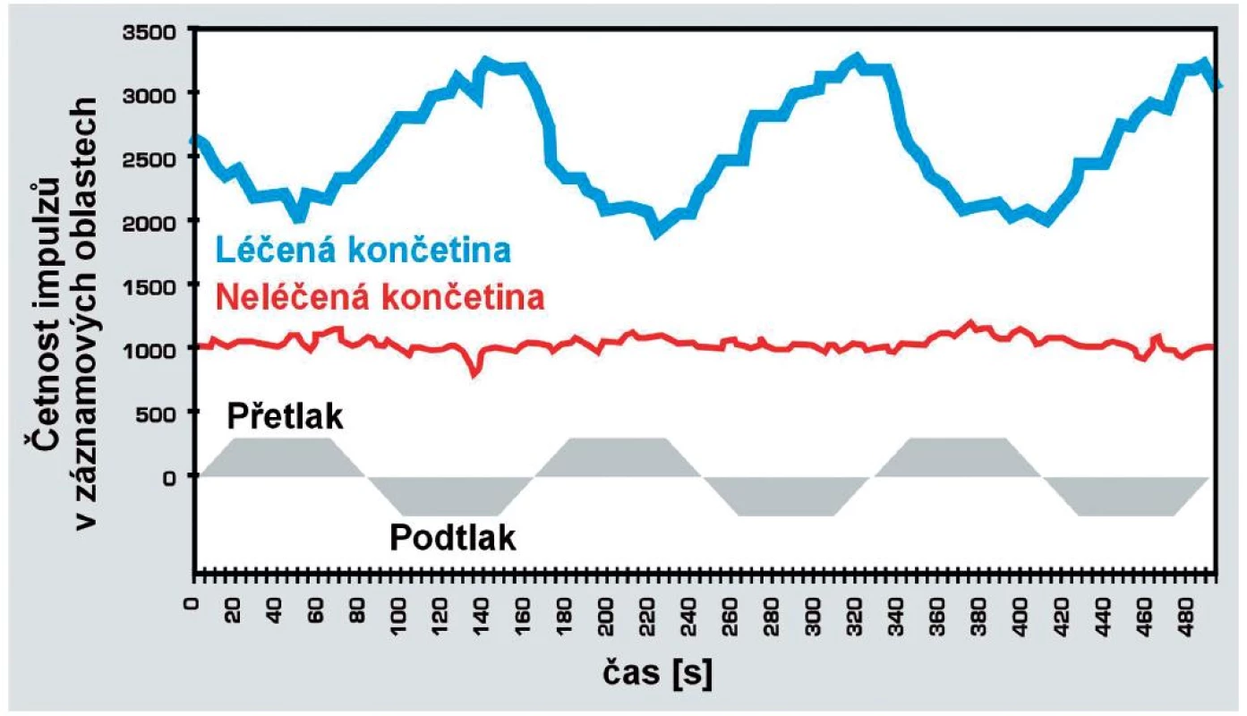 Změna prokrvení léčené i neléčené končetiny v závislosti na cyklech vakuově-kompresní terapie. Vzorkování po 5 sekundách.